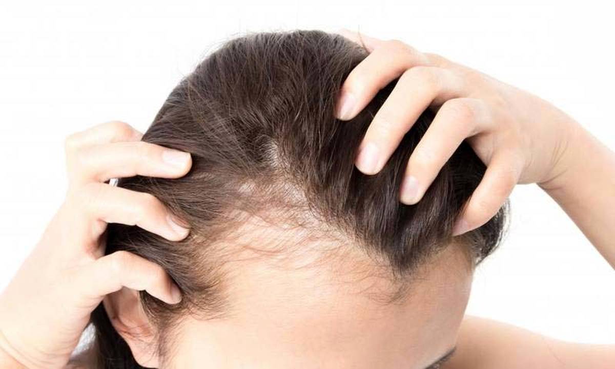 فقط کچلها بخوانند / با ریزش مو چه کنیم؟